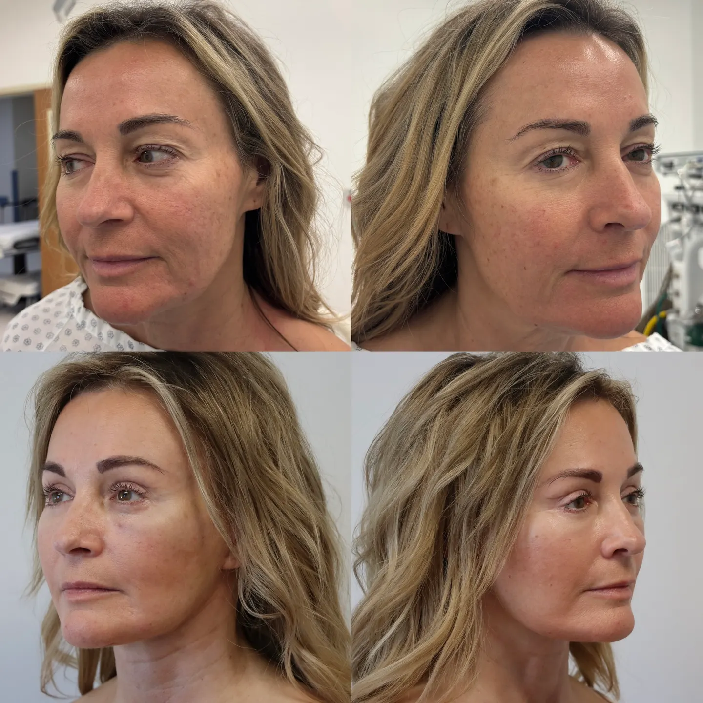 Paciente de lifting facial, tres cuartos, antes y después