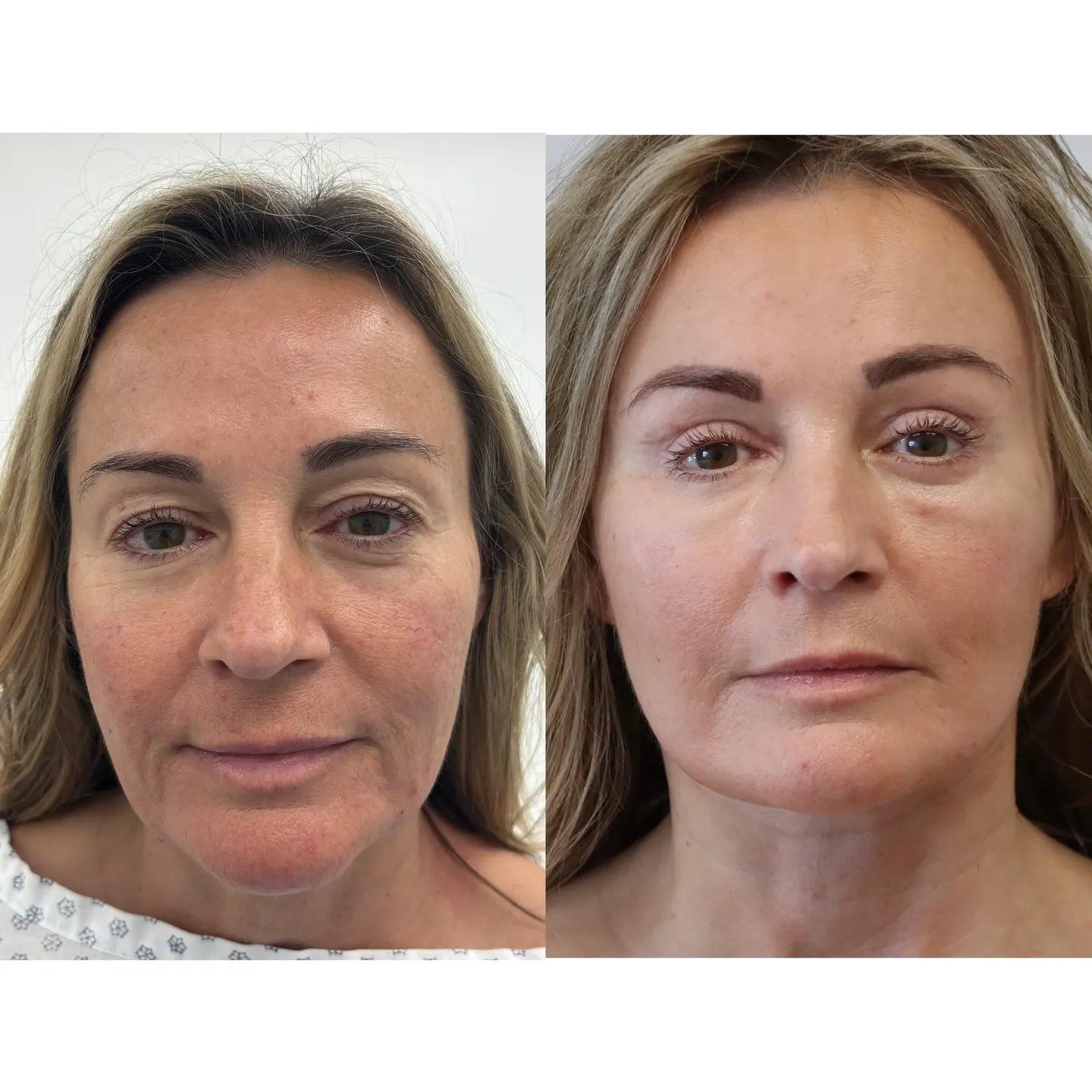 Paciente de lifting facial, de frente, antes y después