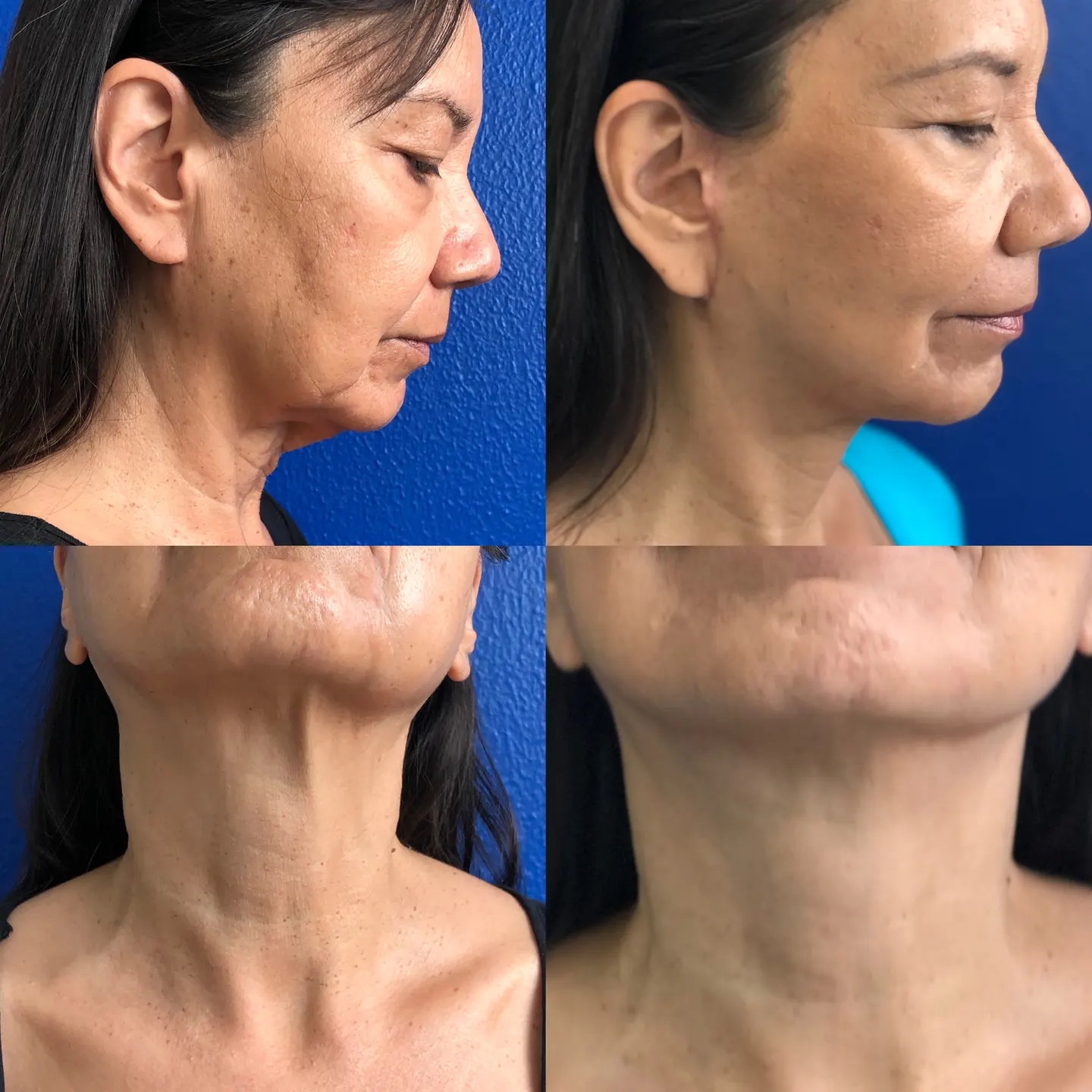 Facelift patient, profile view, before and after