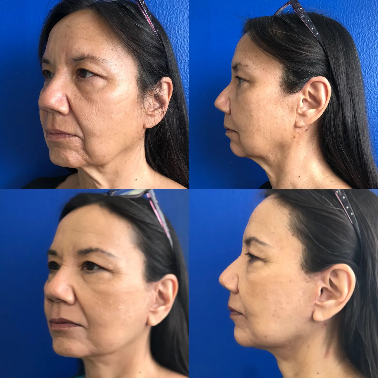 Paciente de lifting facial, perfil y cuello, antes y después
