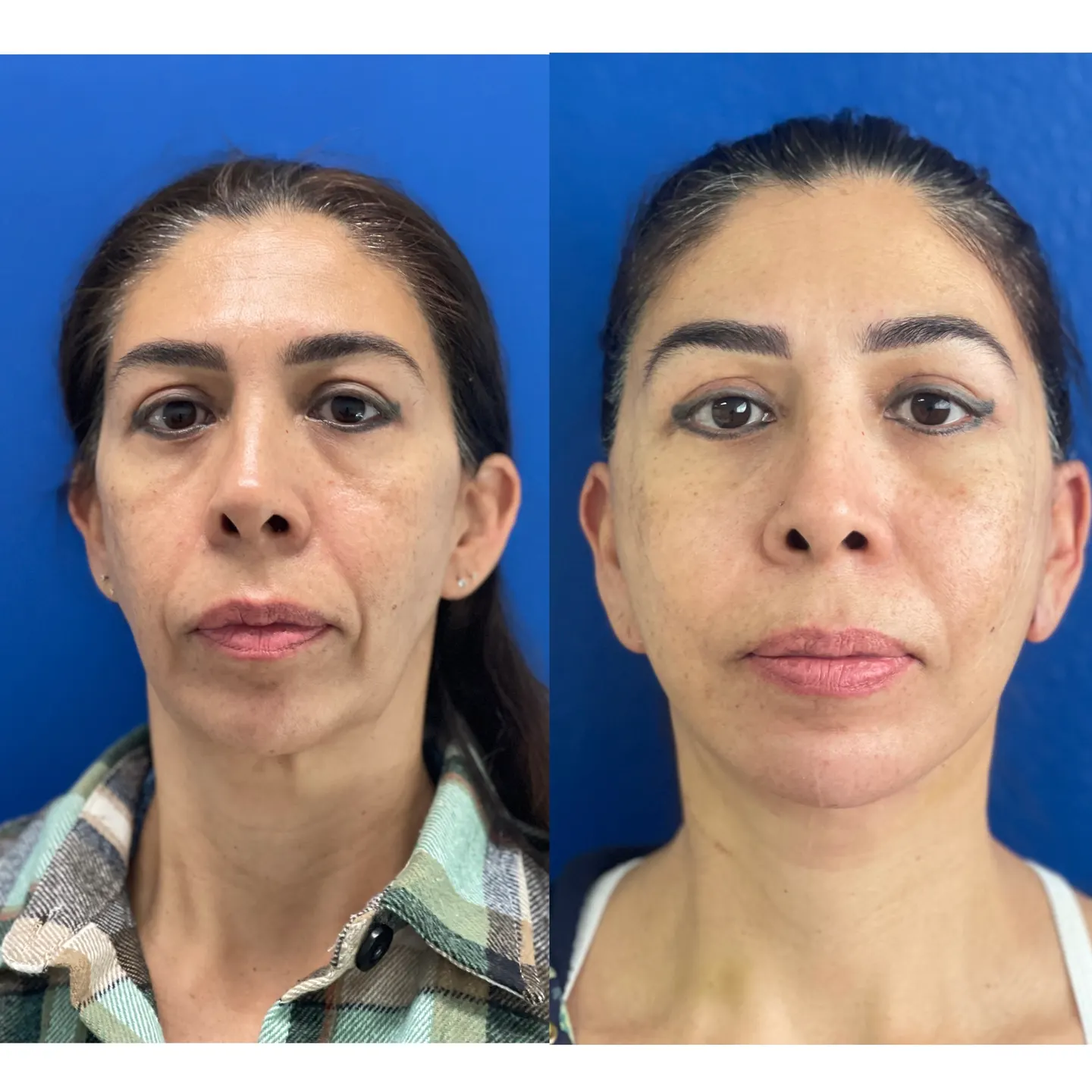Facelift patient, front view, before and after