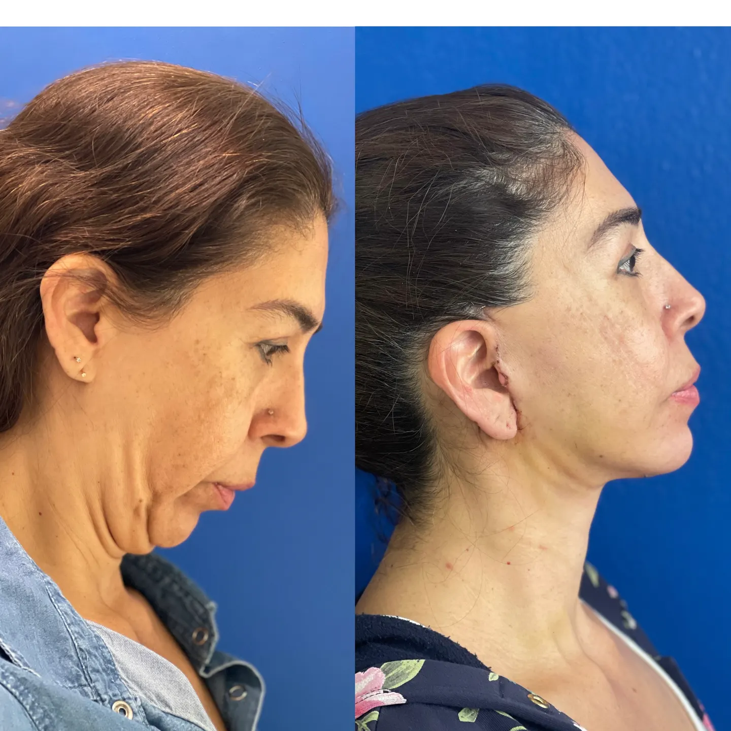 Paciente de lifting facial, de frente y perfil, antes y después