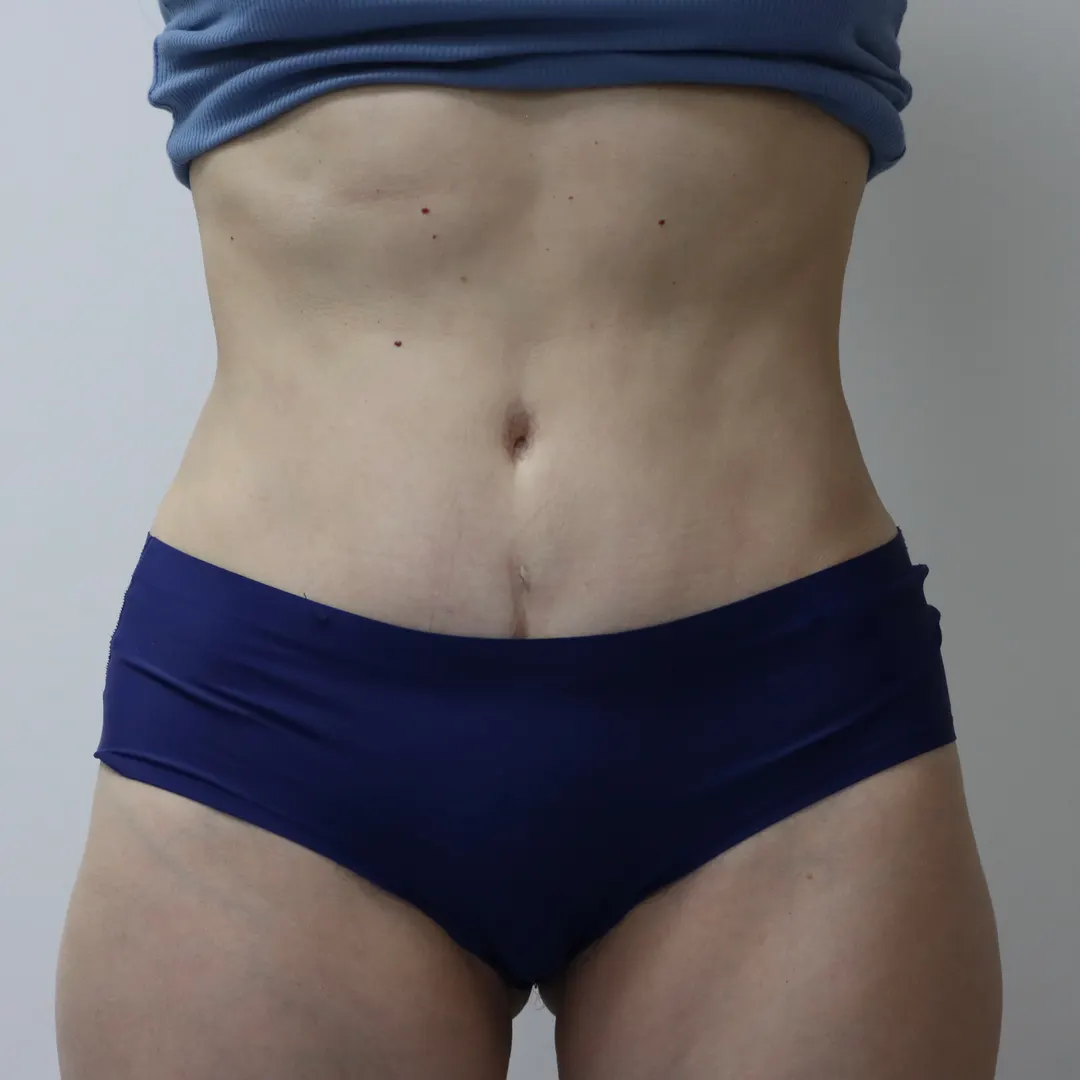 Tummy tuck patient, front view — After